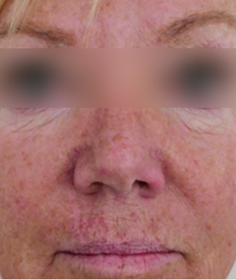 Halo® - Before Image
