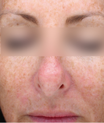 Halo™ - Before Image