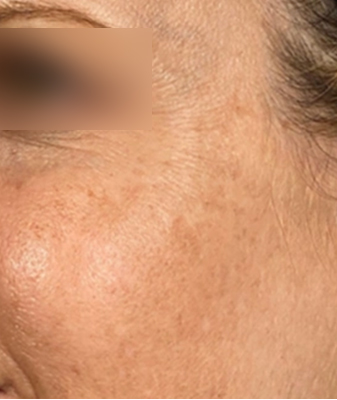 Halo® - Before Image