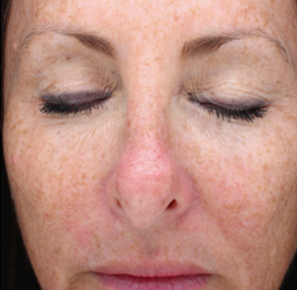 Halo™ - Before Image