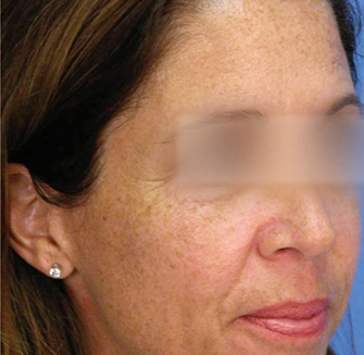 MicroLaserPeel® - Before Image