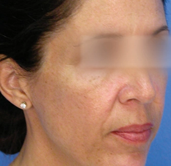 MicroLaserPeel® - After Image