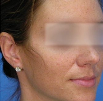 MicroLaserPeel® - Before Image