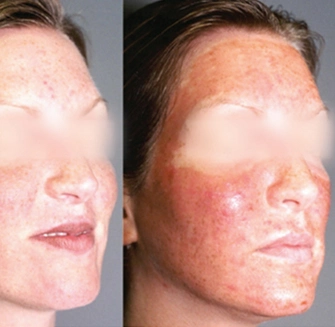 MicroLaserPeel® - Before Image