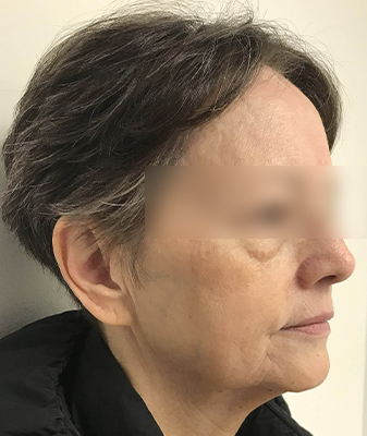 Profac ™ - After Image