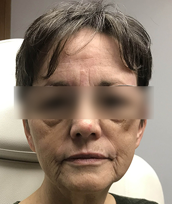 Agnes™ - Before Image