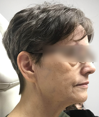 Profac ™ - Before Image