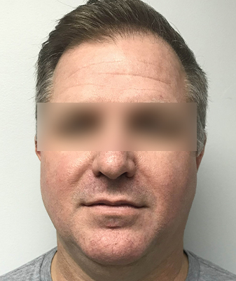 Agnes™ - Before Image