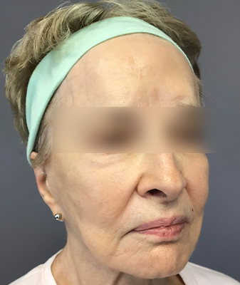 Botox™ - After Image