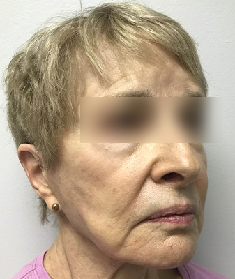Botox™ - Before Image