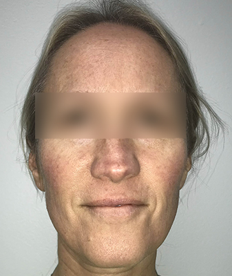 Agnes™ - Before Image