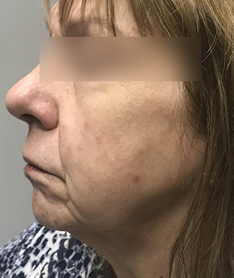 Aquafirme™ - Before Image