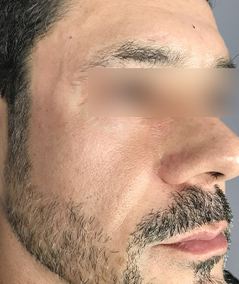Halo™ - Before Image