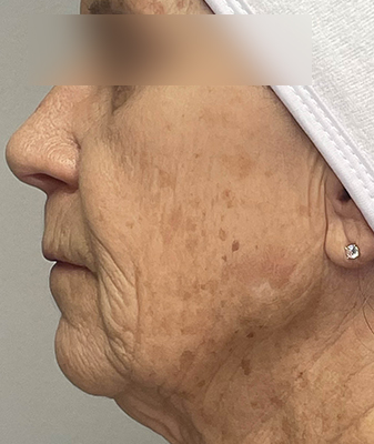Forever Young BBL™ - Before Image