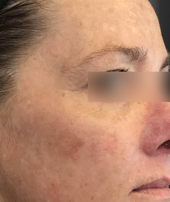 Botox™ - After Image