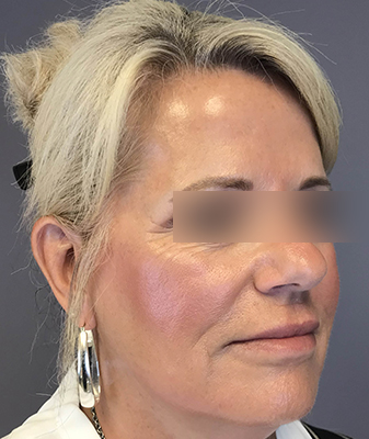 Facial™ - Before Image