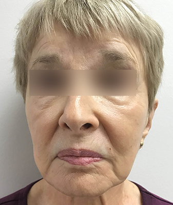 Filler™ - After Image