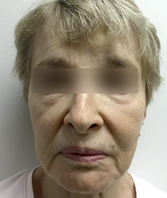 Filler™ - Before Image