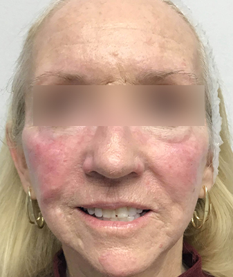 Filler™ - After Image