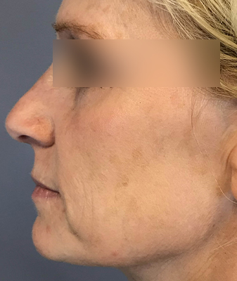Halo™ - Before Image