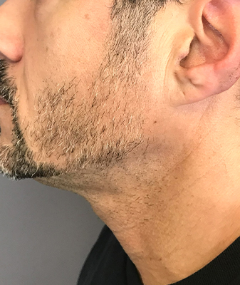 Laser Hair Removal ™ - After Image