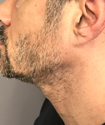 Laser Hair Removal ™ - Before Image