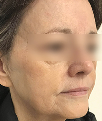 MicroLaserPeel® - After Image
