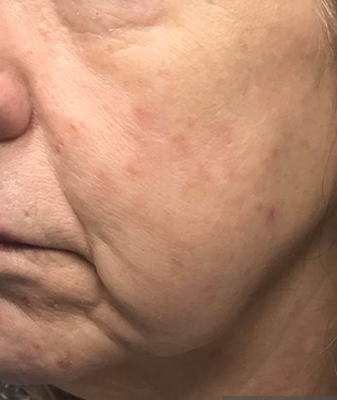 MicroLaserPeel® - After Image