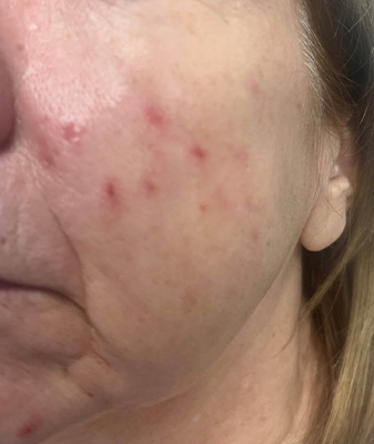 MicroLaserPeel® - Before Image