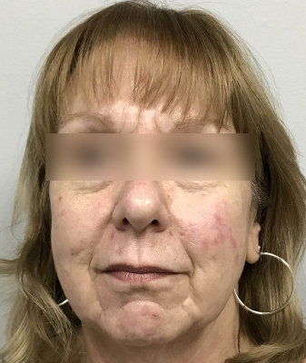 PRP® - After Image