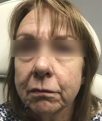 PRP® - Before Image