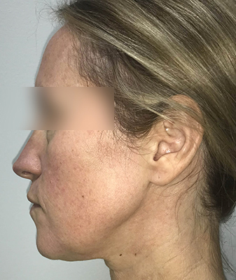 Scarlet ™ - Before Image
