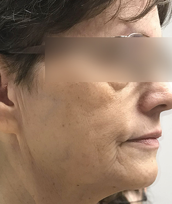Scarlet ™ - Before Image