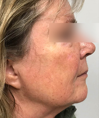 Scarlet ™ - Before Image