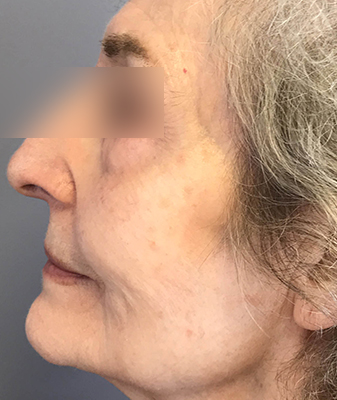 Scarlet ™ - After Image